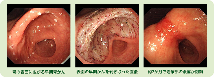 症例②　早期胃がんESD（粘膜下層剥離）