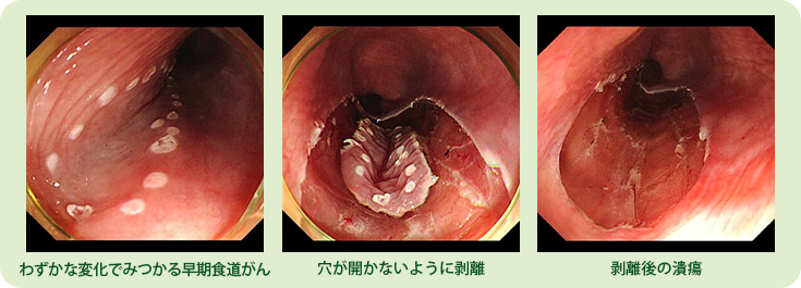 症例③　早期食道がんESD（粘膜下層剥離）