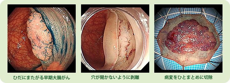 症例④　早期大腸がんESD（粘膜下層剥離）