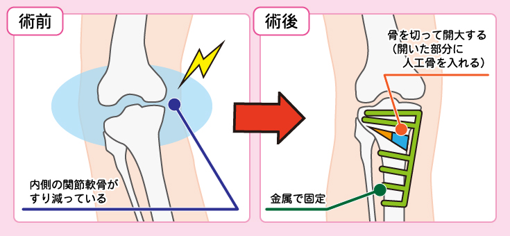 高位脛骨骨切り術（関節温存術）