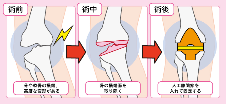 人工膝関節置換術