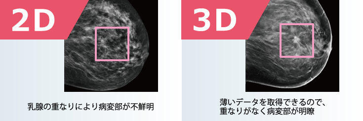杏雲堂病院　放射線技術科　マンモグラフィ画像イメージ