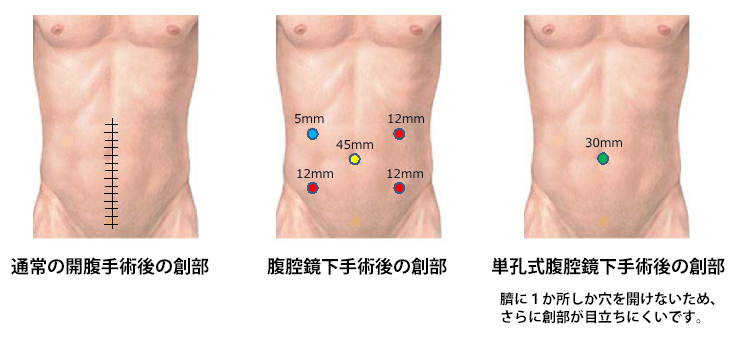 腹腔鏡下手術の創部